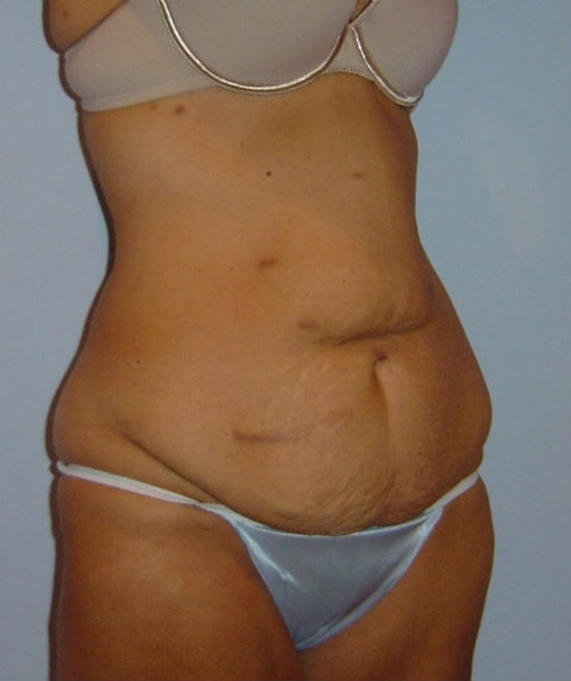 Post Weight Loss Surgery Before & After Gallery - Patient 133023680 - Image 3
