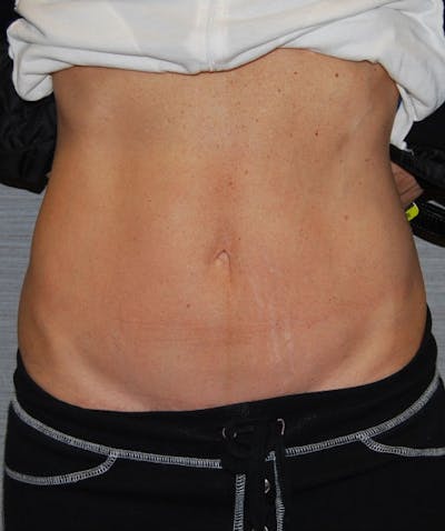 Mini Tummy Tuck Before & After Gallery - Patient 133023671 - Image 2