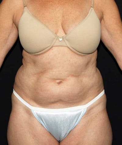 Liposuction Before & After Gallery - Patient 133023674 - Image 1