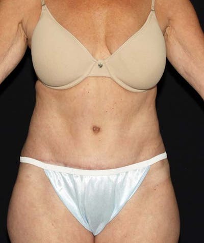 Liposuction Before & After Gallery - Patient 133023674 - Image 2