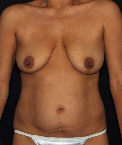Tummy Tuck Before & After Gallery - Patient 133023686 - Image 1