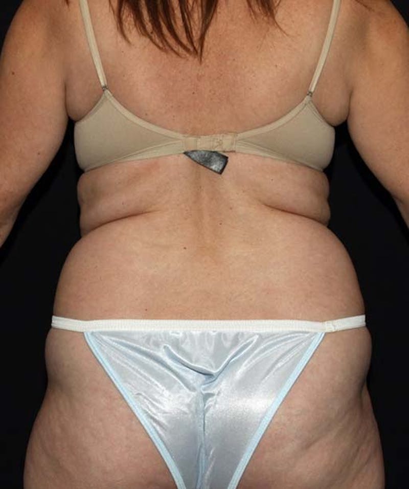 Liposuction Before & After Gallery - Patient 133023674 - Image 3