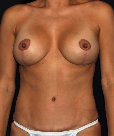 Tummy Tuck Before & After Gallery - Patient 133023686 - Image 2