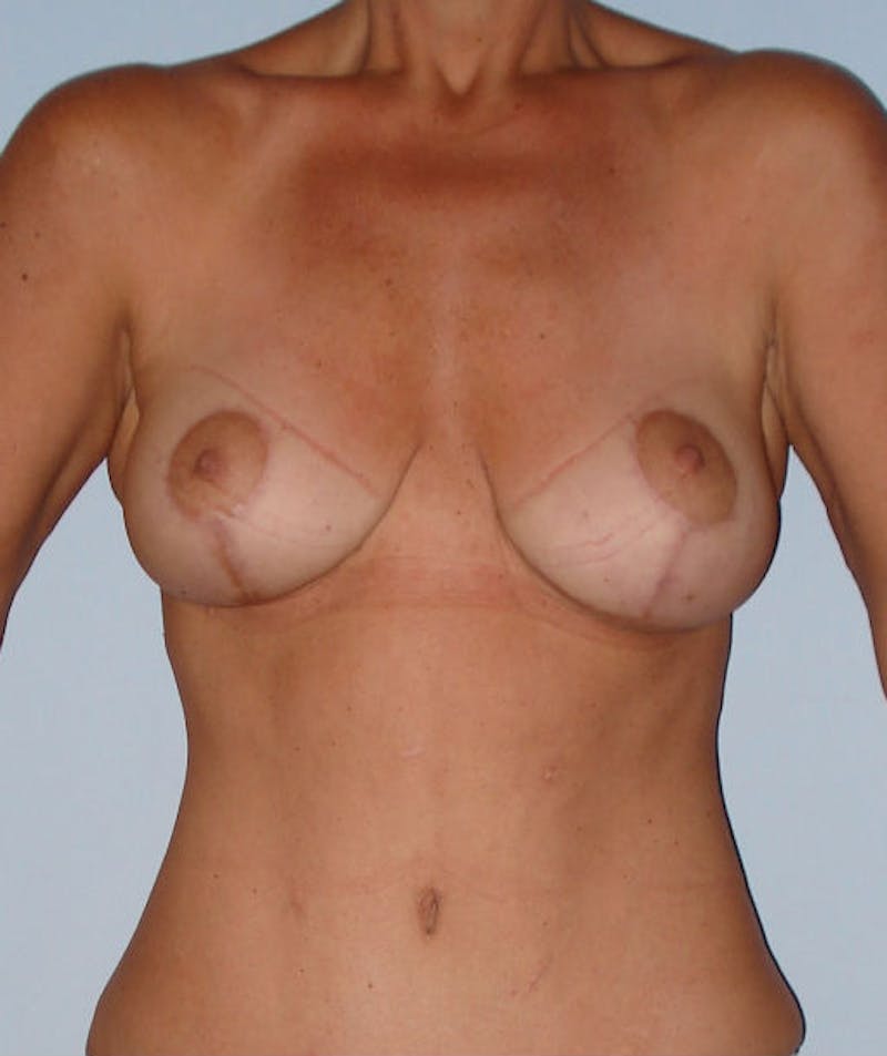 Post Weight Loss Surgery Before & After Gallery - Patient 133023680 - Image 6