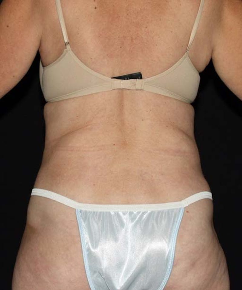 Liposuction Before & After Gallery - Patient 133023674 - Image 4