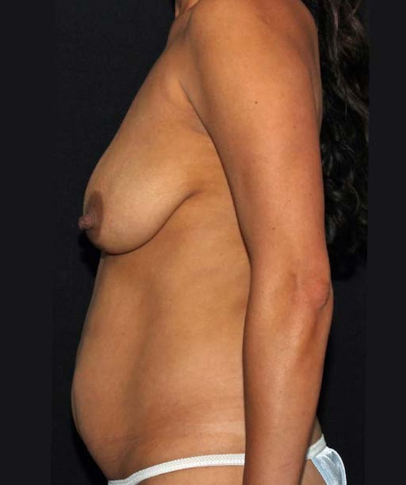 Tummy Tuck Before & After Gallery - Patient 133023686 - Image 5