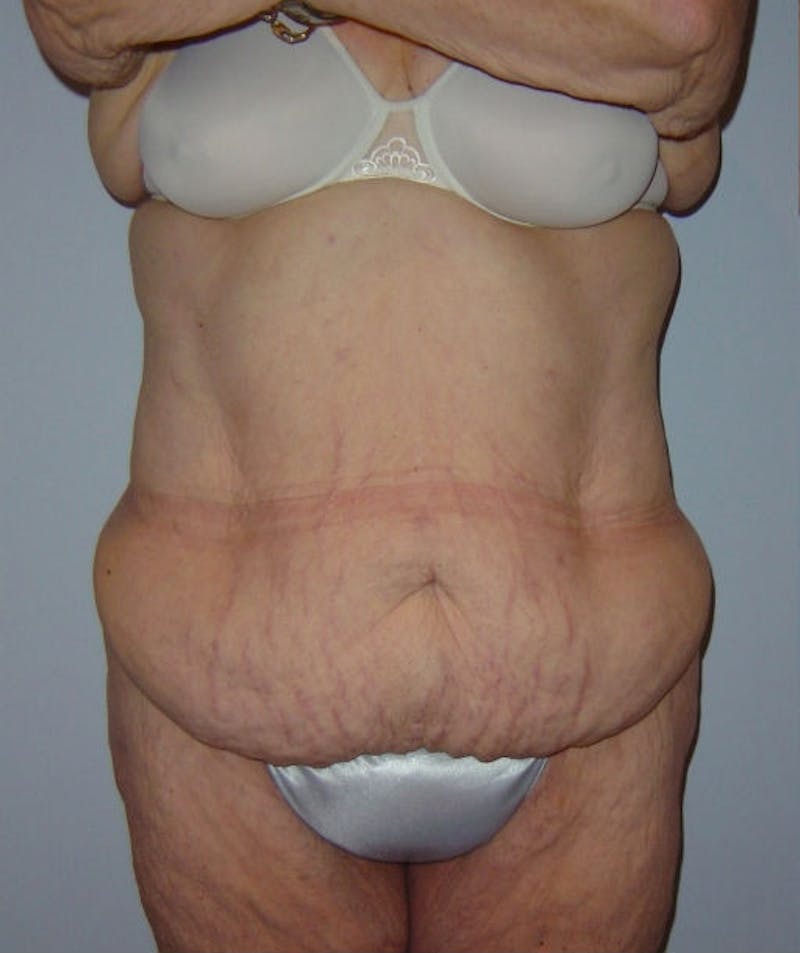 Post Weight Loss Surgery Before & After Gallery - Patient 133023684 - Image 1