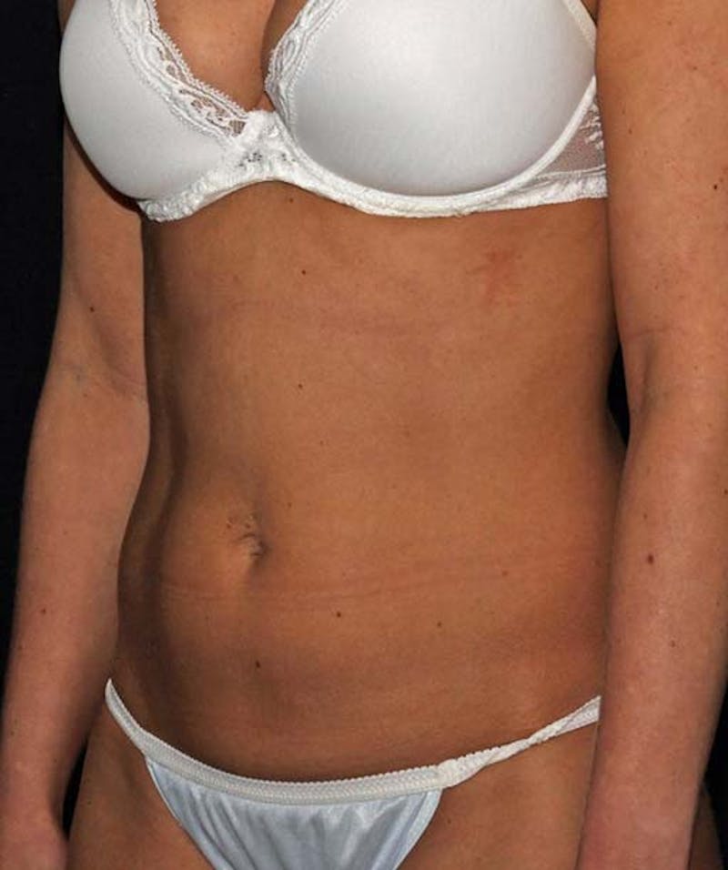 Liposuction Before & After Gallery - Patient 133023685 - Image 3