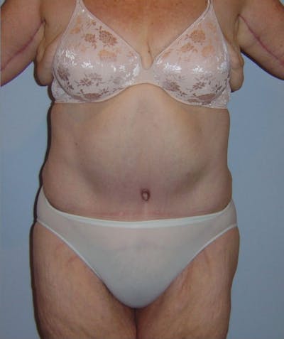 Post Weight Loss Surgery Before & After Gallery - Patient 133023684 - Image 2