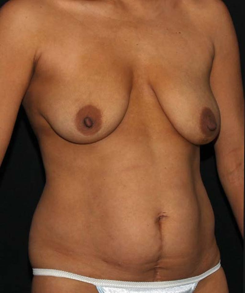 Tummy Tuck Before & After Gallery - Patient 133023686 - Image 7