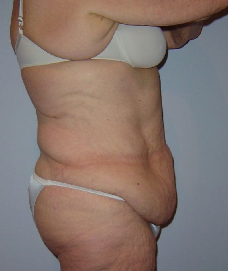 Post Weight Loss Surgery Before & After Gallery - Patient 133023684 - Image 3