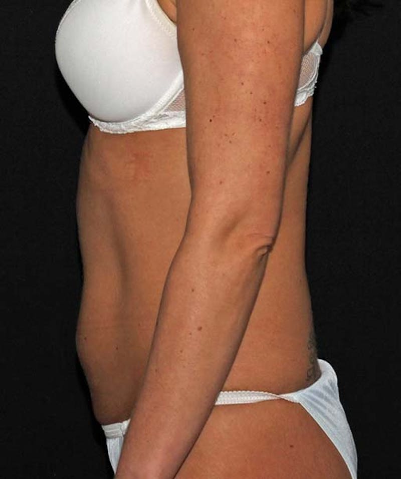 Liposuction Before & After Gallery - Patient 133023685 - Image 5