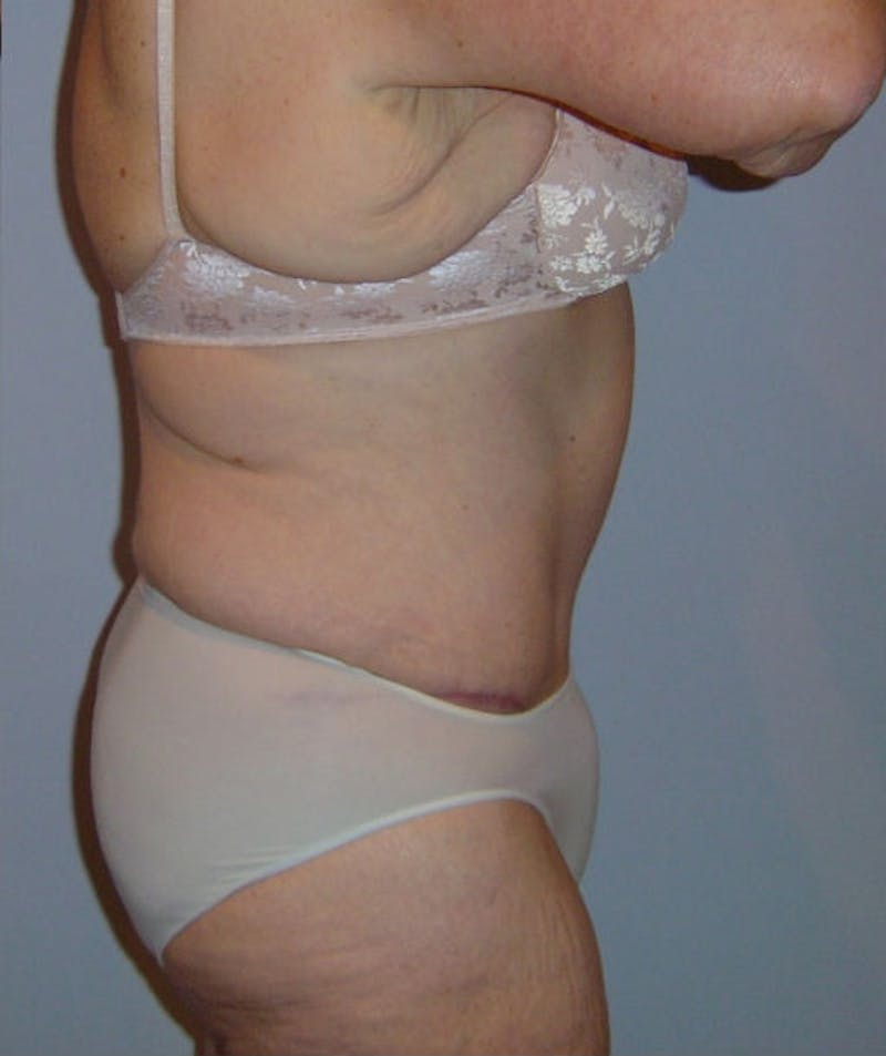 Post Weight Loss Surgery Before & After Gallery - Patient 133023684 - Image 4