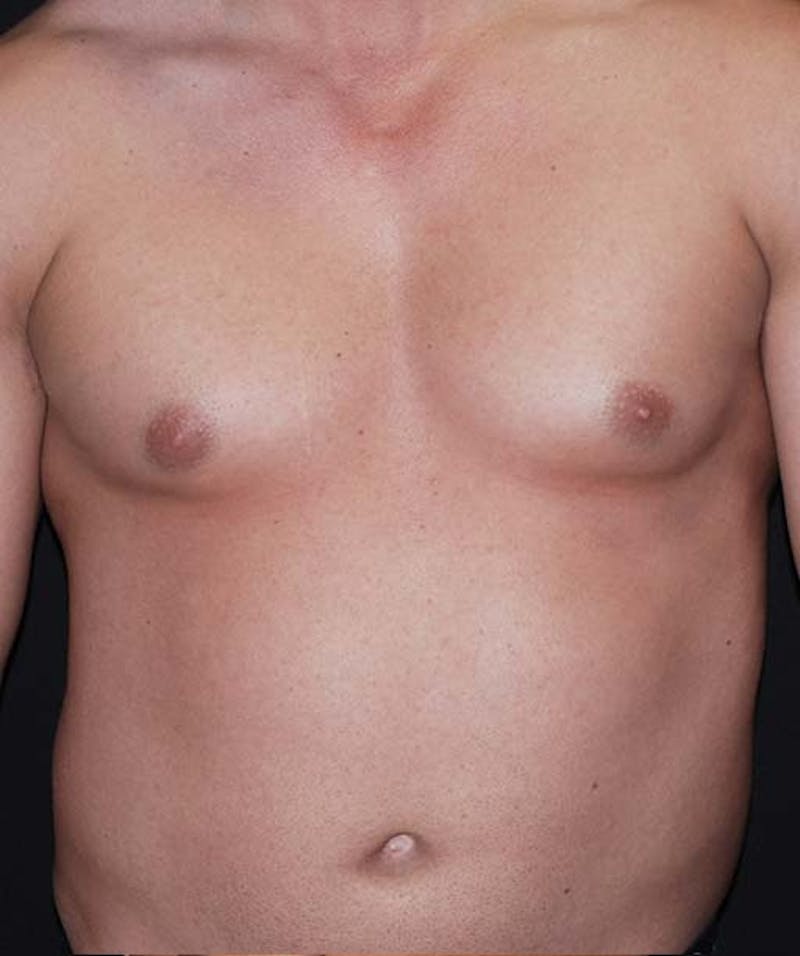 Liposuction Before & After Gallery - Patient 133023688 - Image 1