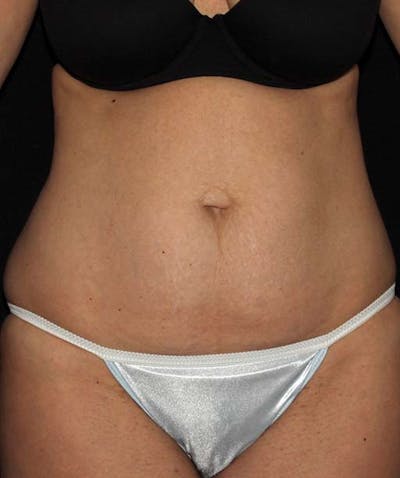 Tummy Tuck Before & After Gallery - Patient 133023692 - Image 1