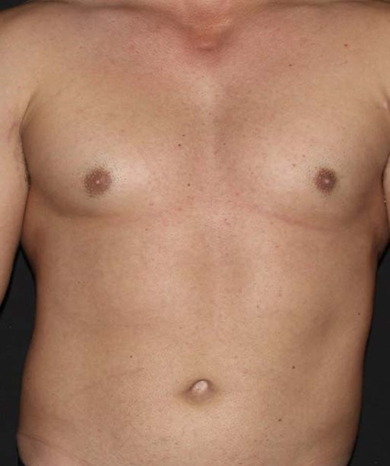 Liposuction Before & After Gallery - Patient 133023688 - Image 2