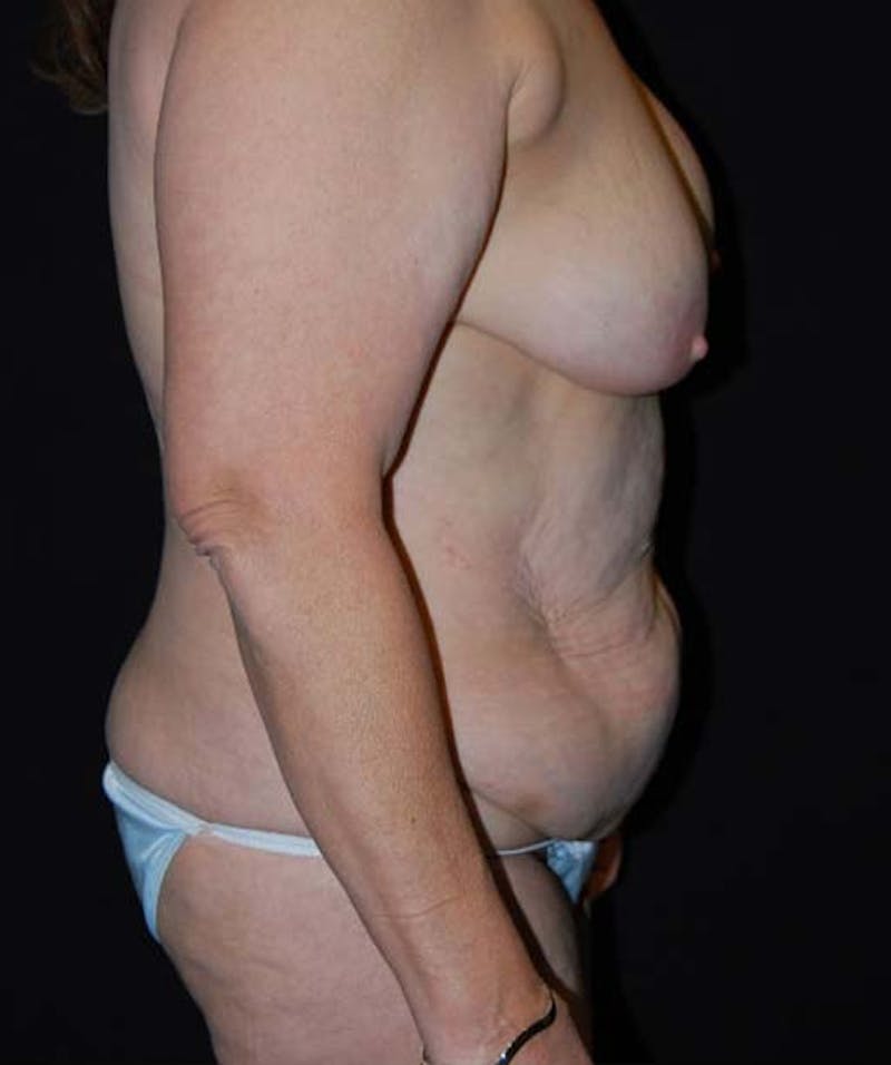 Post Weight Loss Surgery Before & After Gallery - Patient 133023687 - Image 3