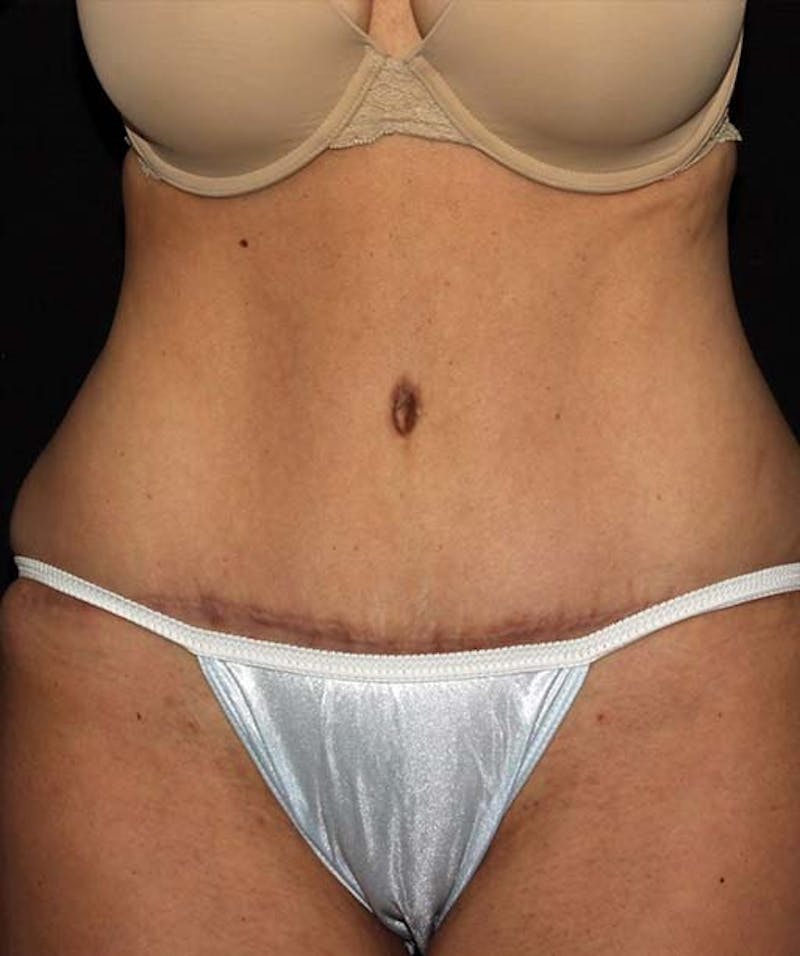 Tummy Tuck Before & After Gallery - Patient 133023692 - Image 2