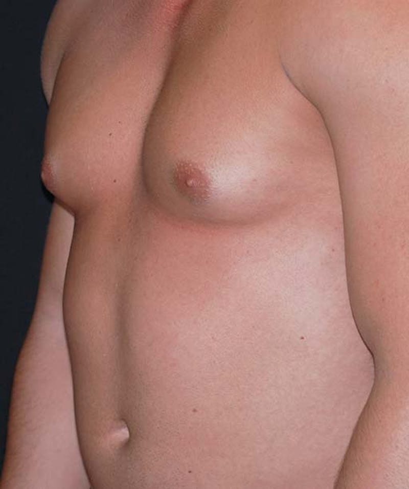 Liposuction Before & After Gallery - Patient 133023688 - Image 3