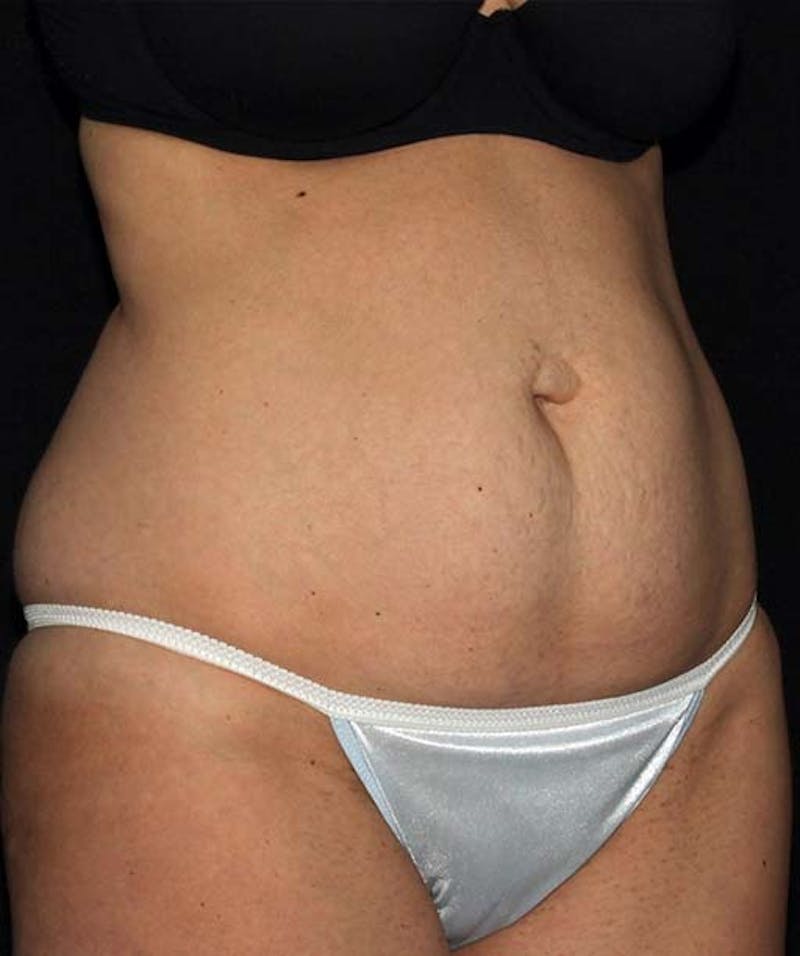 Tummy Tuck Before & After Gallery - Patient 133023692 - Image 3