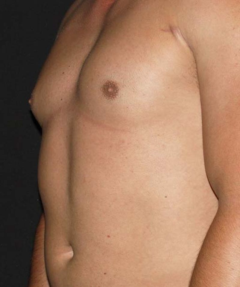 Liposuction Before & After Gallery - Patient 133023688 - Image 4