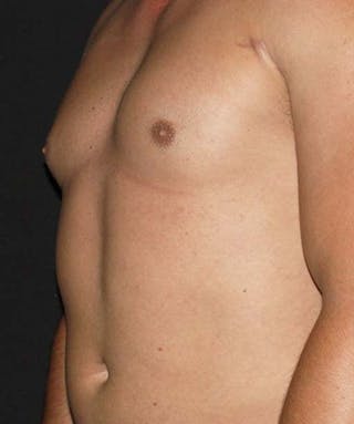 Liposuction Before & After Gallery - Patient 133023688 - Image 4