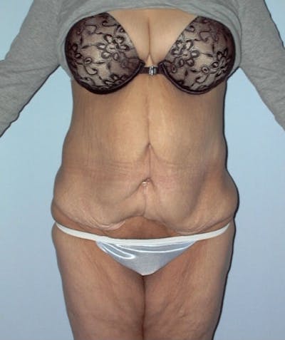 Post Weight Loss Surgery Before & After Gallery - Patient 133023693 - Image 1