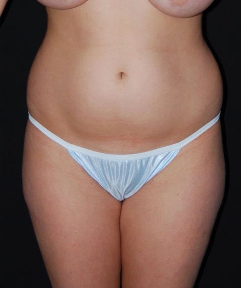 Liposuction Before & After Gallery - Patient 133023696 - Image 1