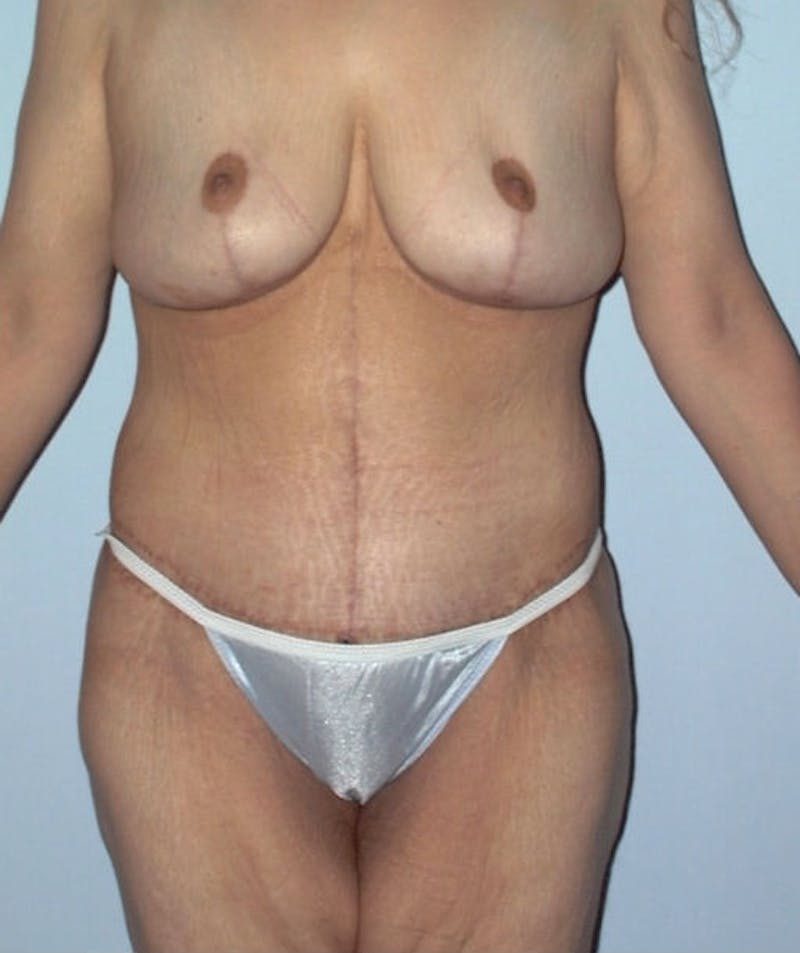 Post Weight Loss Surgery Before & After Gallery - Patient 133023693 - Image 2