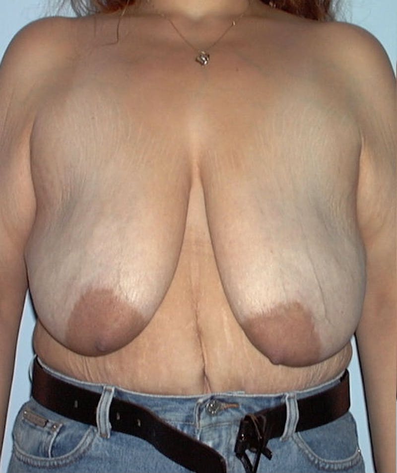 Post Weight Loss Surgery Before & After Gallery - Patient 133023693 - Image 3