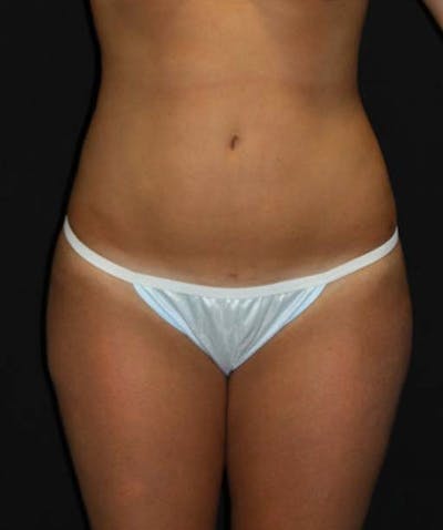Liposuction Before & After Gallery - Patient 133023696 - Image 2