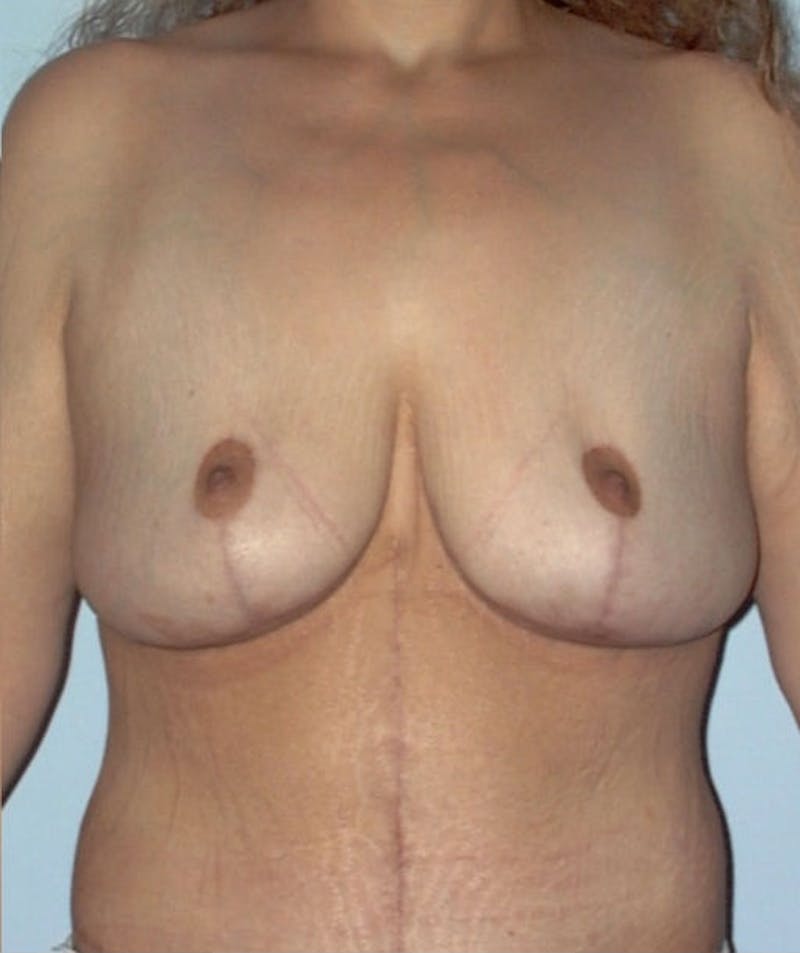 Post Weight Loss Surgery Before & After Gallery - Patient 133023693 - Image 4