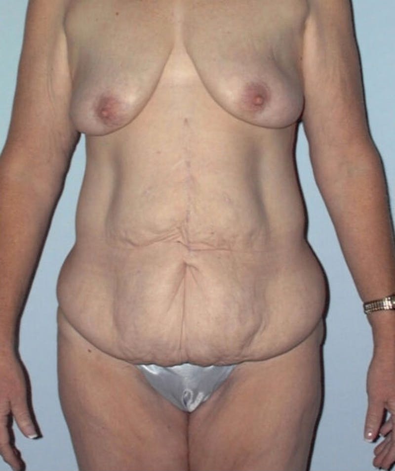 Post Weight Loss Surgery Before & After Gallery - Patient 133023698 - Image 1
