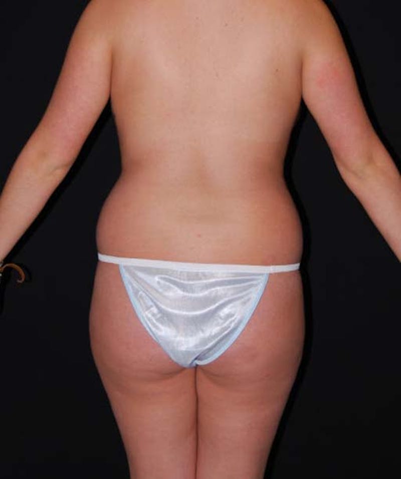 Liposuction Before & After Gallery - Patient 133023696 - Image 5