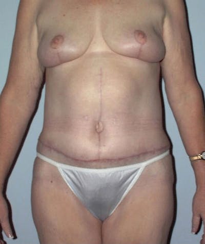 Post Weight Loss Surgery Before & After Gallery - Patient 133023698 - Image 2