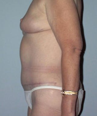 Post Weight Loss Surgery Before & After Gallery - Patient 133023698 - Image 4