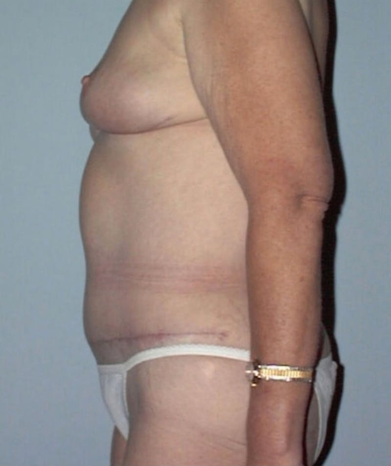 Post Weight Loss Surgery Before & After Gallery - Patient 133023698 - Image 4