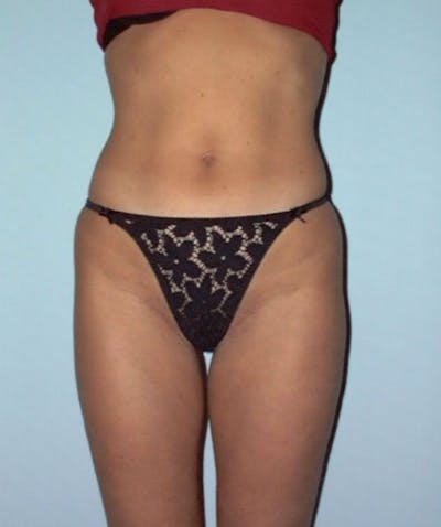 Liposuction Before & After Gallery - Patient 133023700 - Image 1