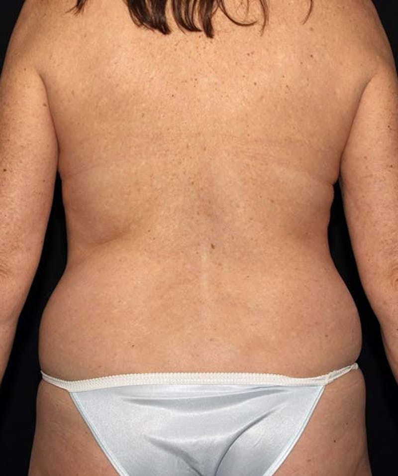 Tummy Tuck Before & After Gallery - Patient 133023699 - Image 5