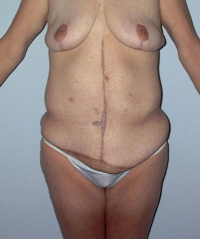 Post Weight Loss Surgery Before & After Gallery - Patient 133023701 - Image 1