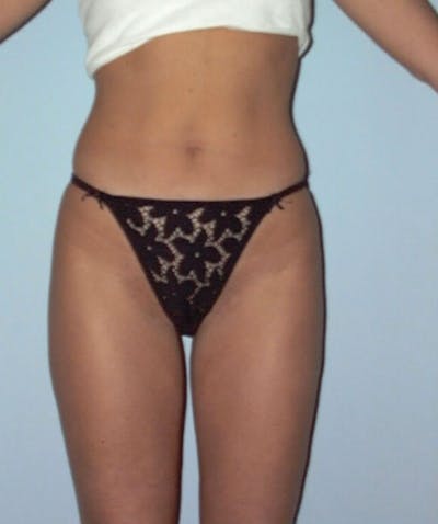 Liposuction Before & After Gallery - Patient 133023700 - Image 2