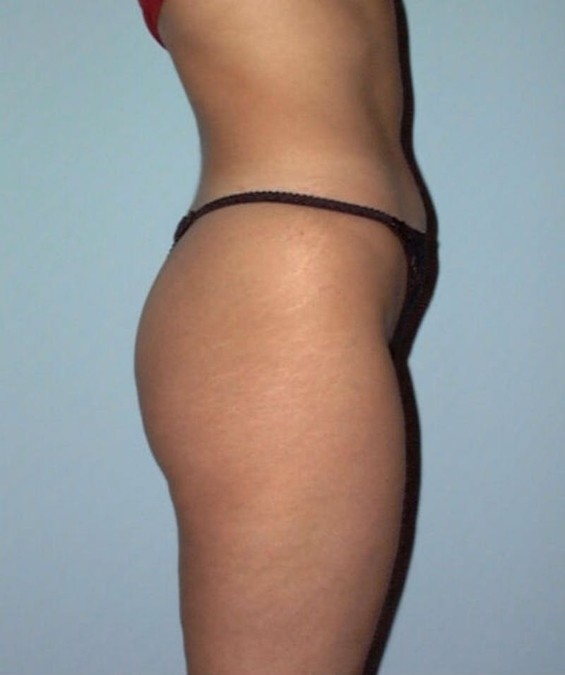 Liposuction Before & After Gallery - Patient 133023700 - Image 3
