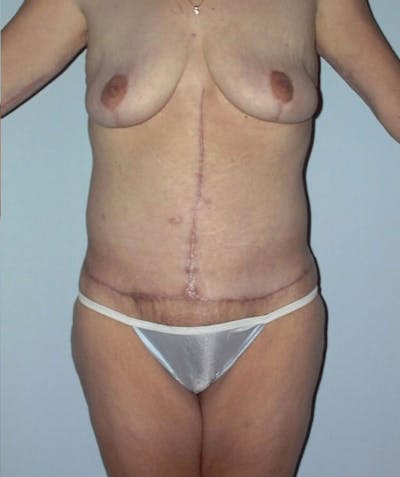 Post Weight Loss Surgery Before & After Gallery - Patient 133023701 - Image 2