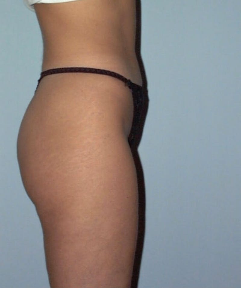 Liposuction Before & After Gallery - Patient 133023700 - Image 4