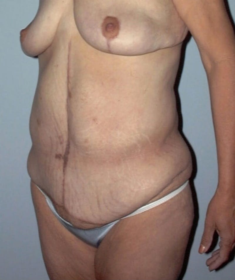 Post Weight Loss Surgery Before & After Gallery - Patient 133023701 - Image 3
