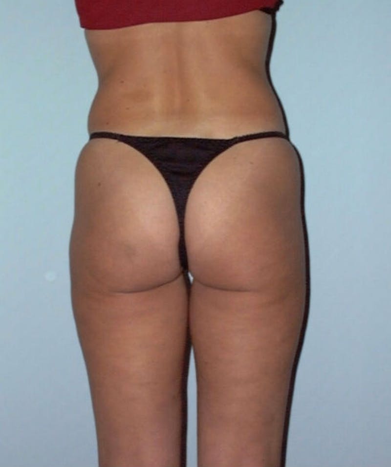 Liposuction Before & After Gallery - Patient 133023700 - Image 5