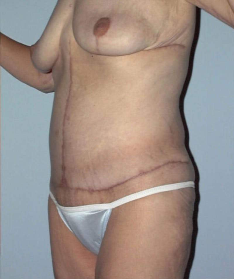 Post Weight Loss Surgery Before & After Gallery - Patient 133023701 - Image 4