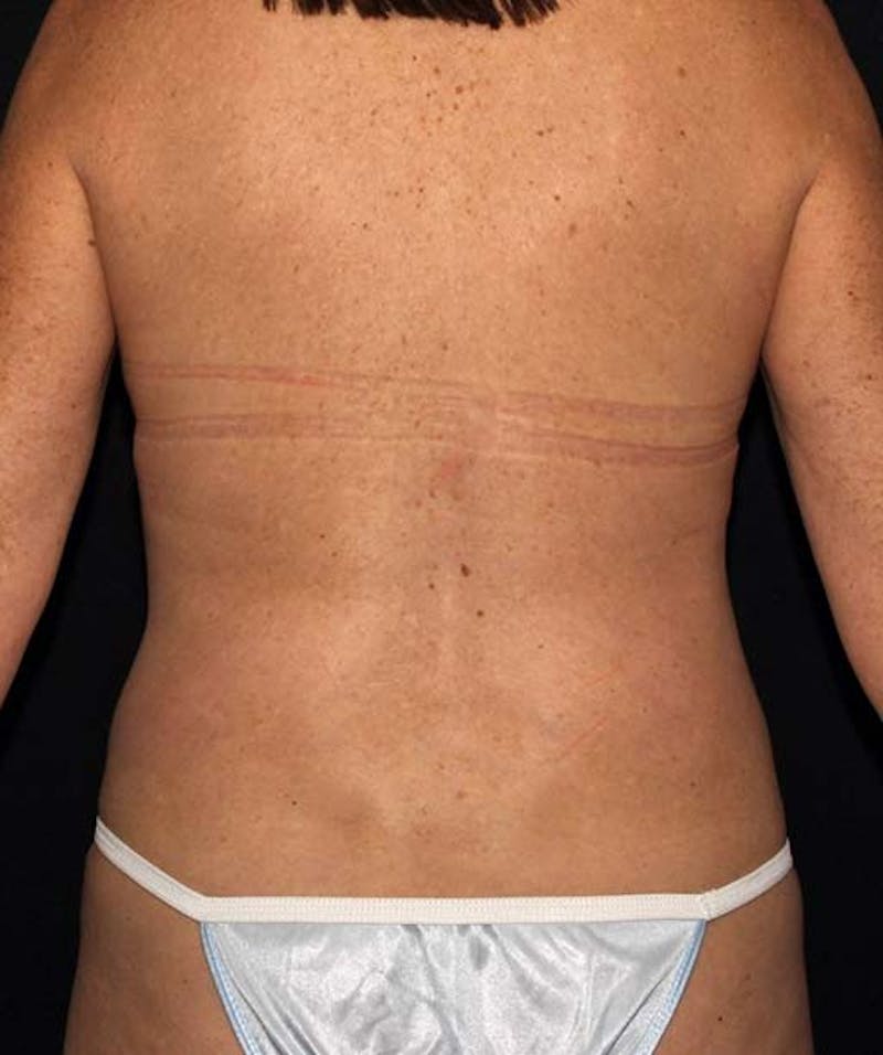 Tummy Tuck Before & After Gallery - Patient 133023699 - Image 6