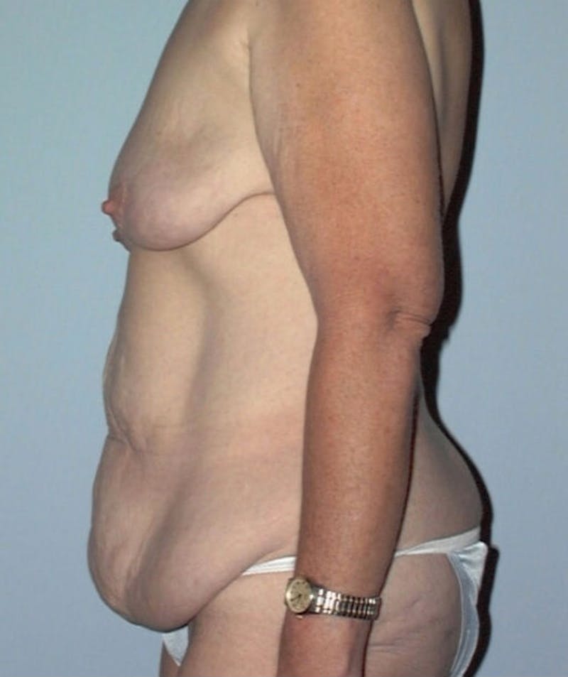 Post Weight Loss Surgery Before & After Gallery - Patient 133023701 - Image 5