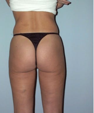 Liposuction Before & After Gallery - Patient 133023700 - Image 6